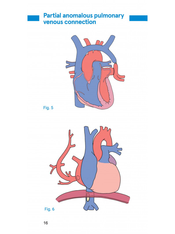 Pocketbook of congenital heart disease