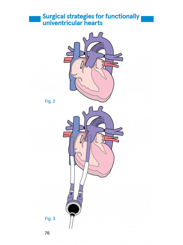 Pocketbook of congenital heart disease